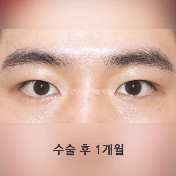 쌍꺼풀 없애기 AFTER