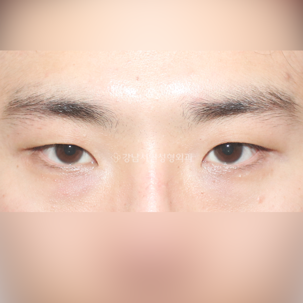 남자눈매교정 BEFORE