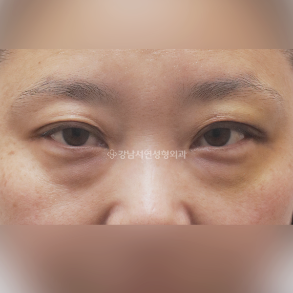 눈밑지방재배치 BEFORE
