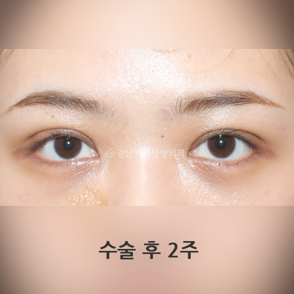 쌍꺼풀재수술 겹주름 교정(2주차) AFTER