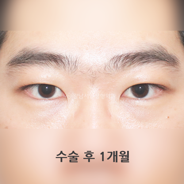 남자 무쌍눈매교정 AFTER