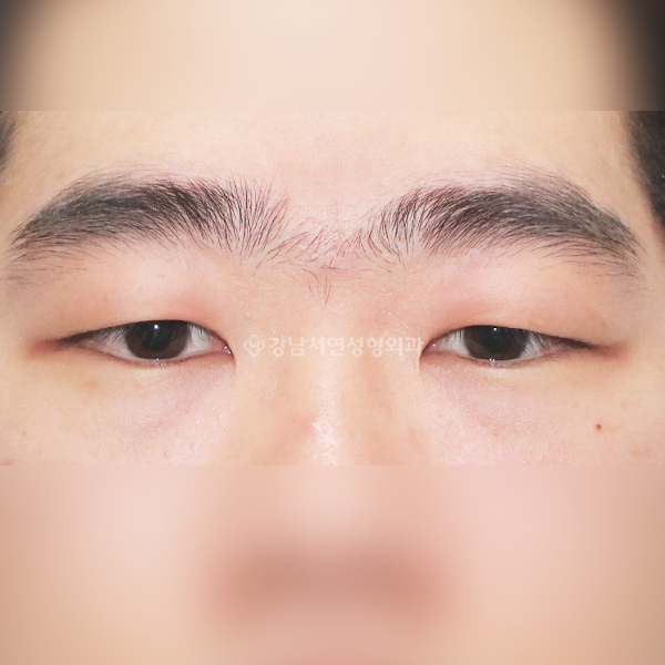 남자 무쌍눈매교정 BEFORE