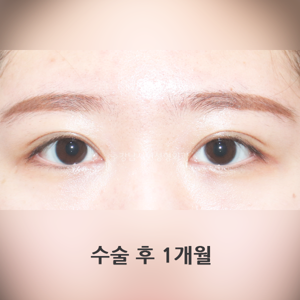 매몰 쌍꺼풀 재수술 AFTER