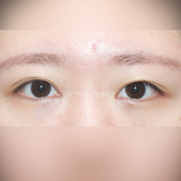 매몰 쌍꺼풀 재수술 BEFORE