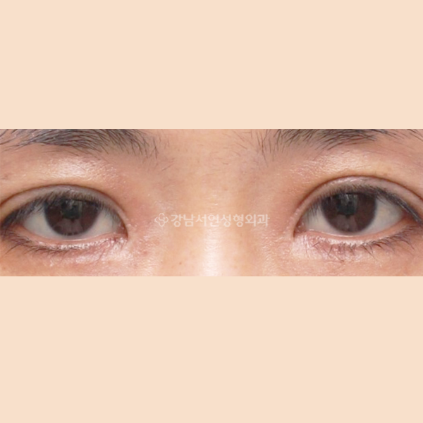 앞트임 복원 AFTER
