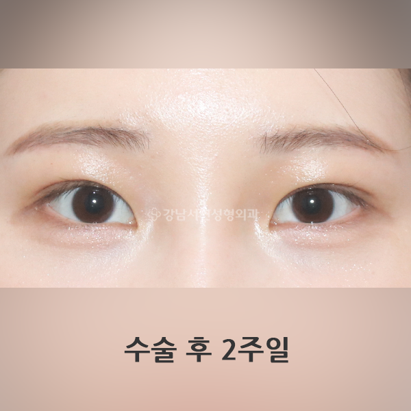 쌍꺼풀 라인낮추기 두줄따기 AFTER