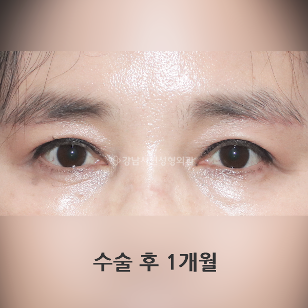 눈썹하거상 AFTER
