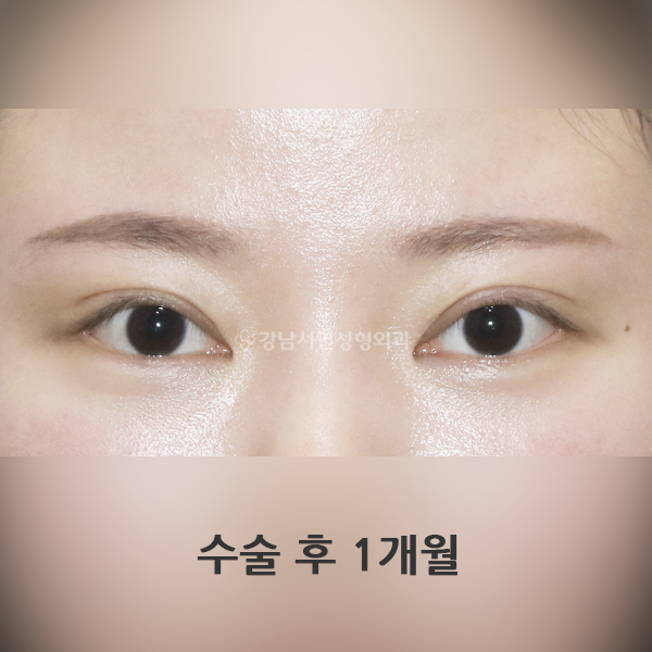 라인 낮추기 AFTER