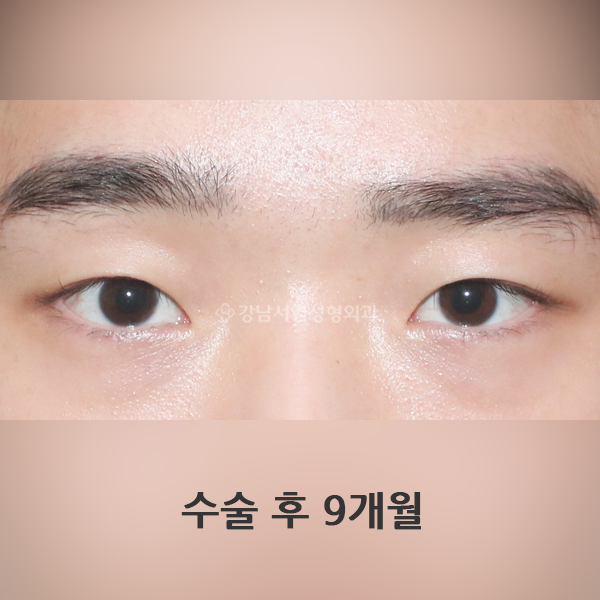 무쌍눈매교정 AFTER