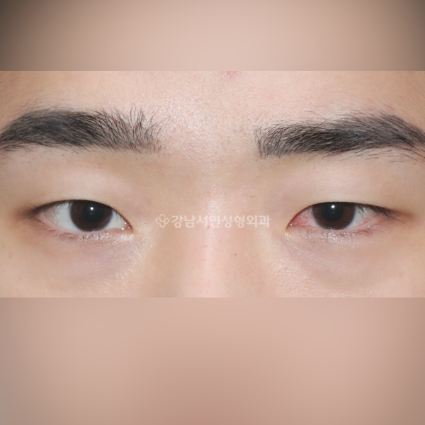 무쌍눈매교정 BEFORE