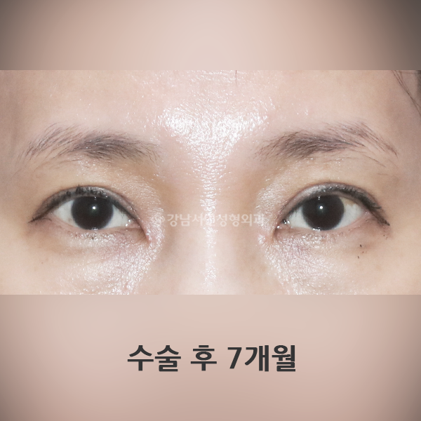 두줄따기 라인낮추기 AFTER