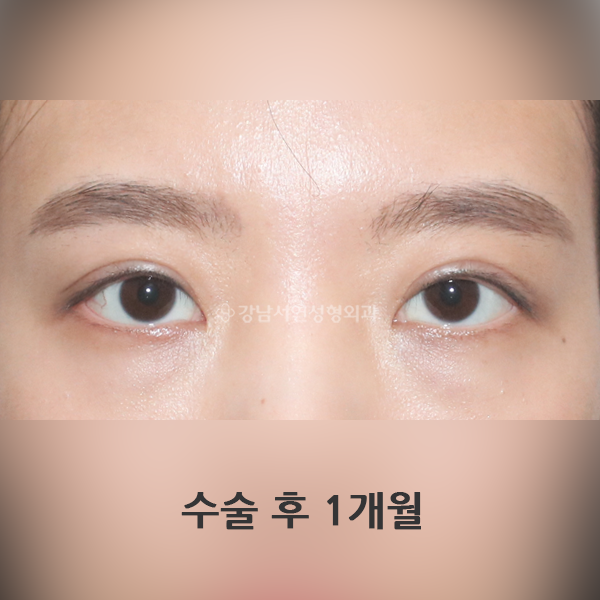 비대칭 교정 AFTER