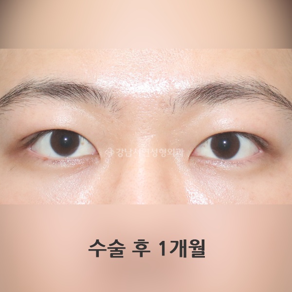 남자 쌍꺼풀 없애기 AFTER