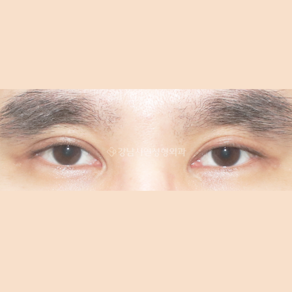 앞트임 복원 BEFORE