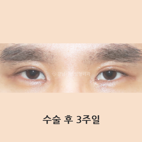 앞트임 복원 AFTER