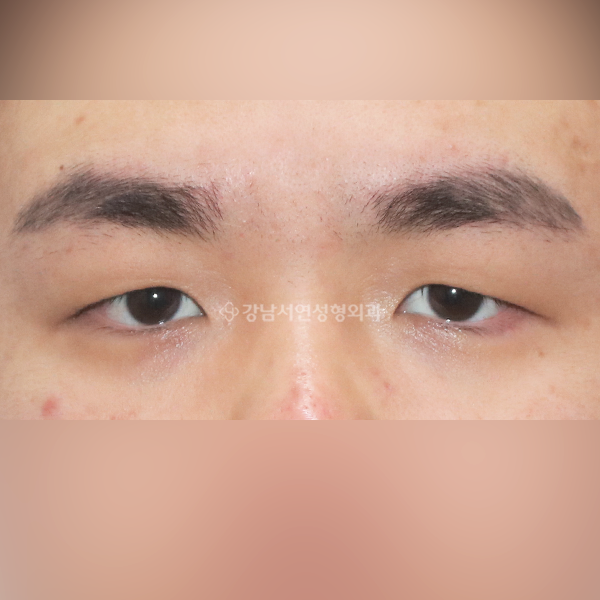 남자 (무쌍)속쌍꺼풀 BEFORE