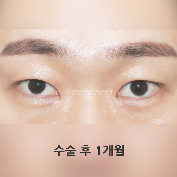 남자 무쌍눈매교정 AFTER