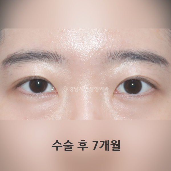 절개눈매교정 AFTER