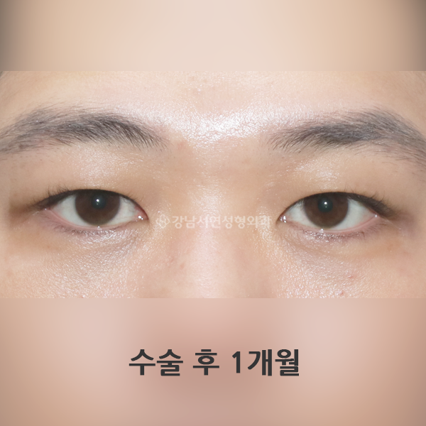 남자 무쌍(속쌍)눈매교정 AFTER