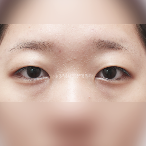절개눈매교정+앞트임 BEFORE