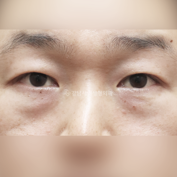 눈밑지방재배치 BEFORE