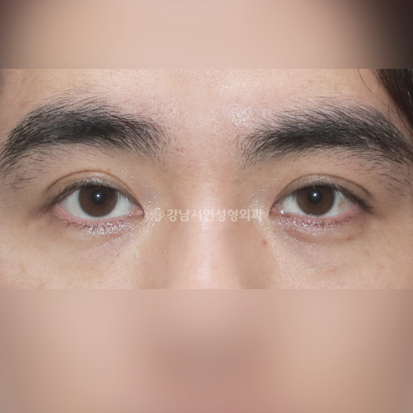 쌍꺼풀 낮추기 BEFORE