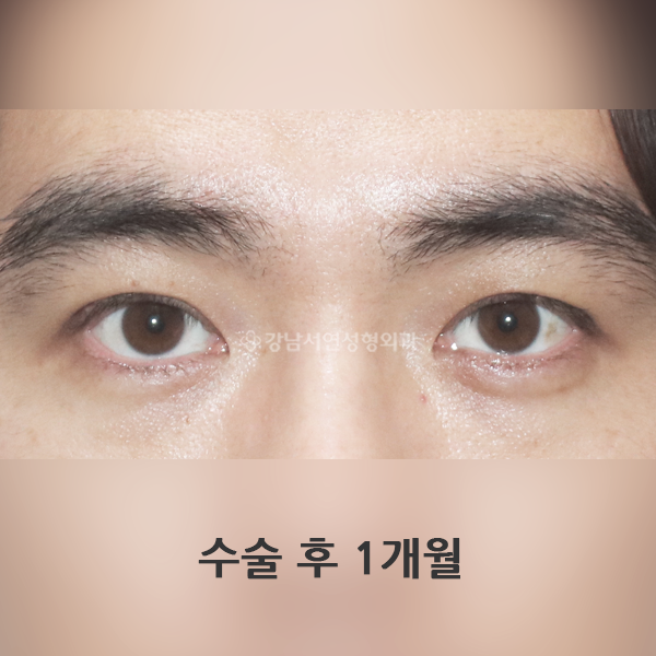 쌍꺼풀 낮추기 AFTER