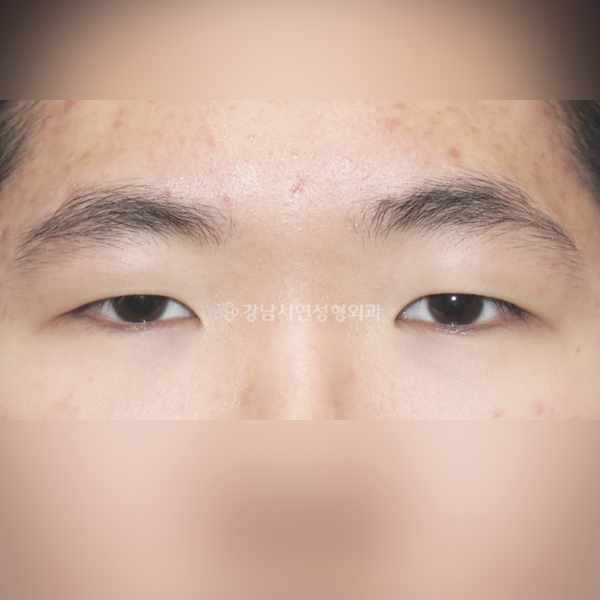 남자 무쌍눈매교정 BEFORE