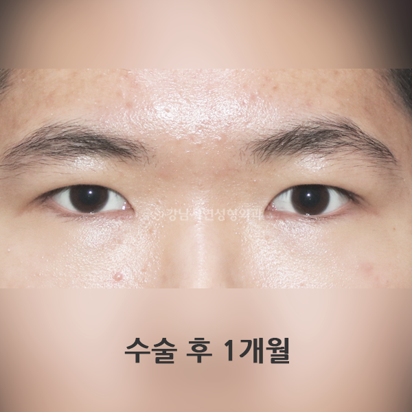 남자 무쌍눈매교정 AFTER