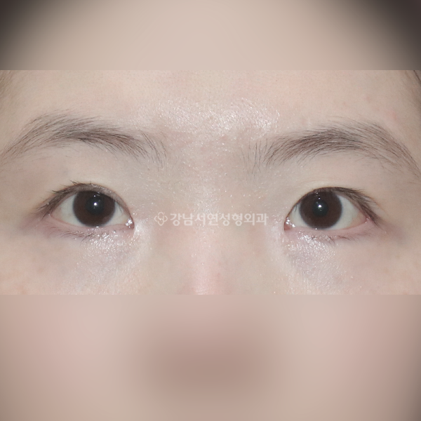 점막 들림, 라인 높이기, 퇴축 교정 BEFORE