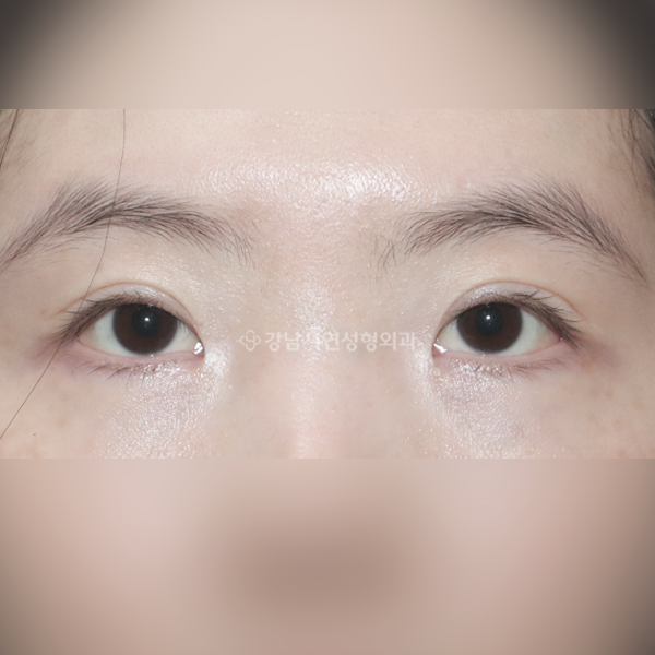 점막 들림, 라인 높이기, 퇴축 교정 AFTER