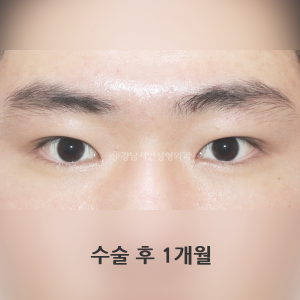 남자 무쌍(속쌍)눈매교정 AFTER