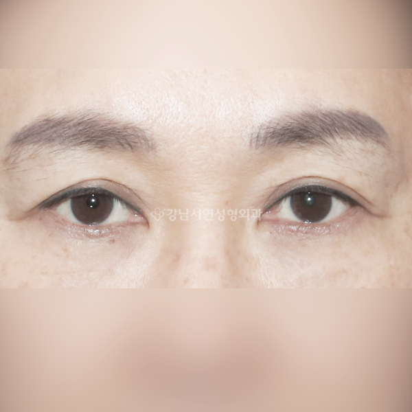 눈썹하거상 BEFORE