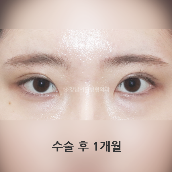 짝눈 교정 AFTER