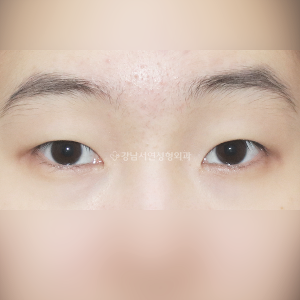 매몰 쌍꺼풀 BEFORE