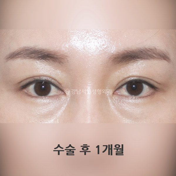 상안검 AFTER
