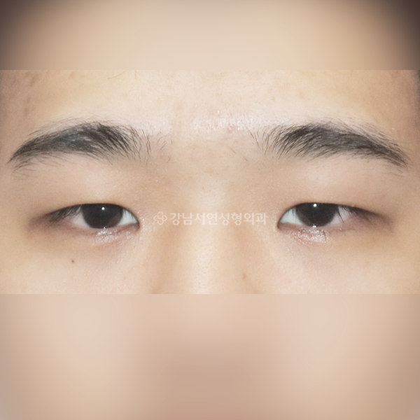 남자 무쌍눈매교정 BEFORE
