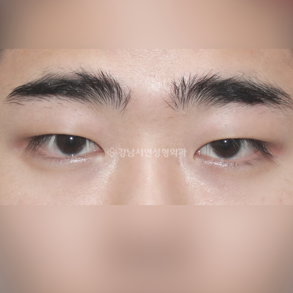 남자 무쌍(속쌍)눈매교정 BEFORE