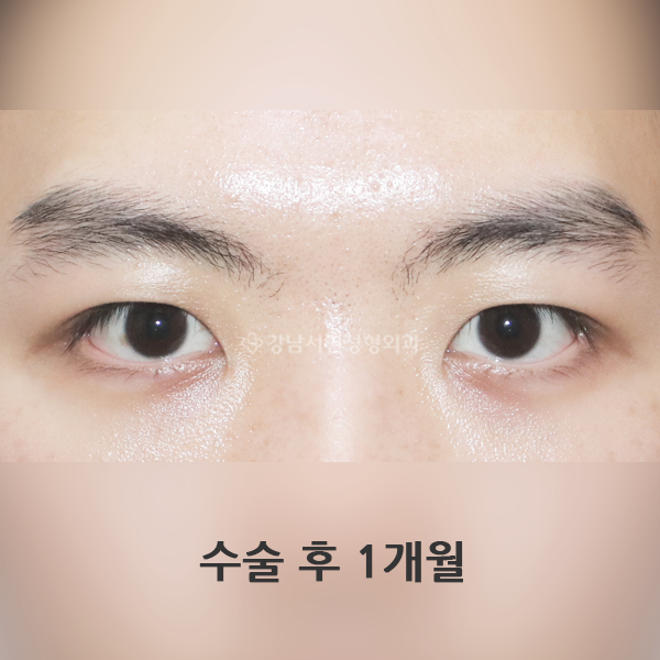 남자 무쌍눈매교정 AFTER