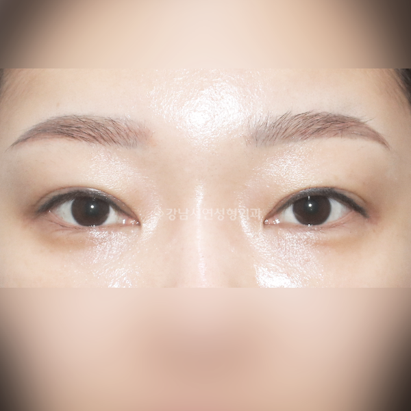 쌍꺼풀 풀림 재수술 AFTER