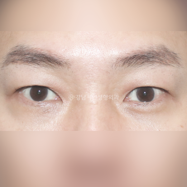 남자 짝눈 교정 AFTER
