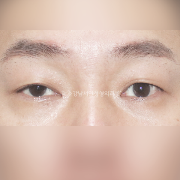 남자 짝눈 교정 BEFORE