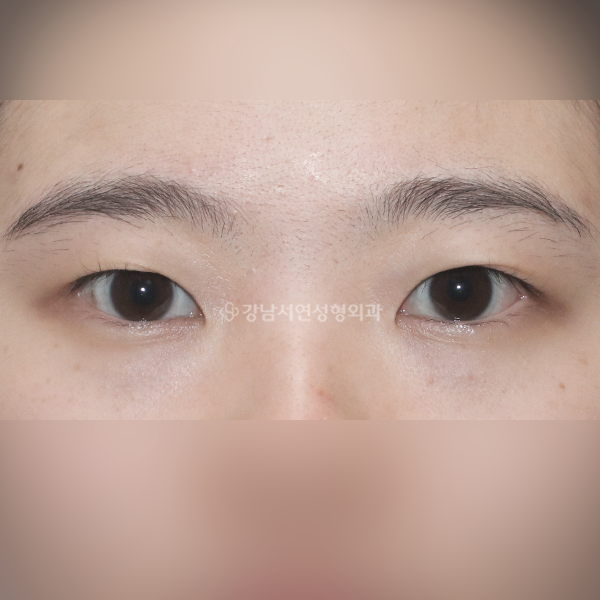 매몰쌍꺼풀+앞트임 BEFORE