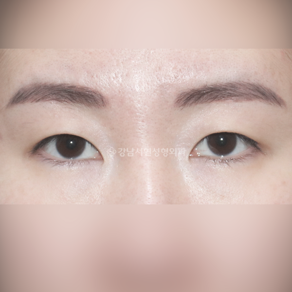 상안검+앞트임 BEFORE