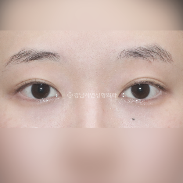 라인 낮추기 BEFORE