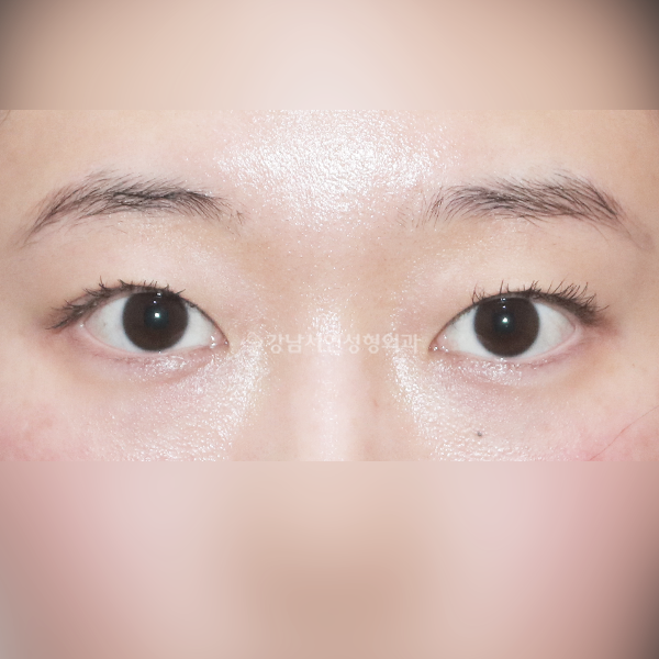 라인 낮추기 AFTER