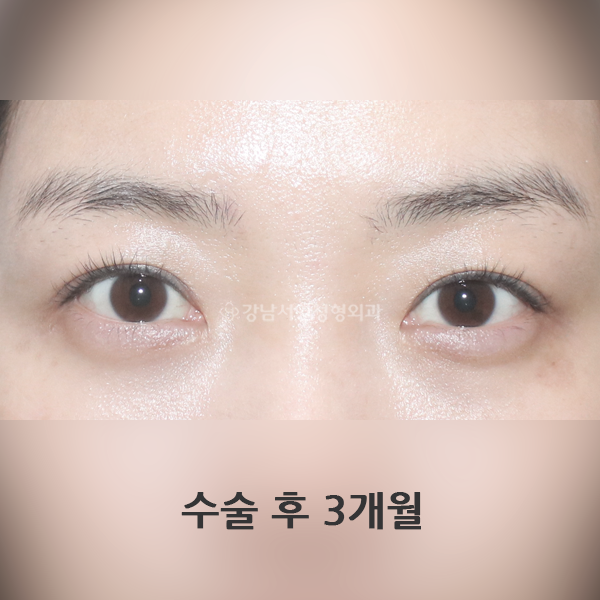 절개 쌍꺼풀 재수술 AFTER