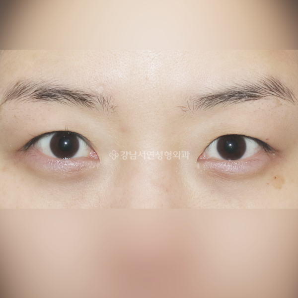 절개 쌍꺼풀 재수술 BEFORE