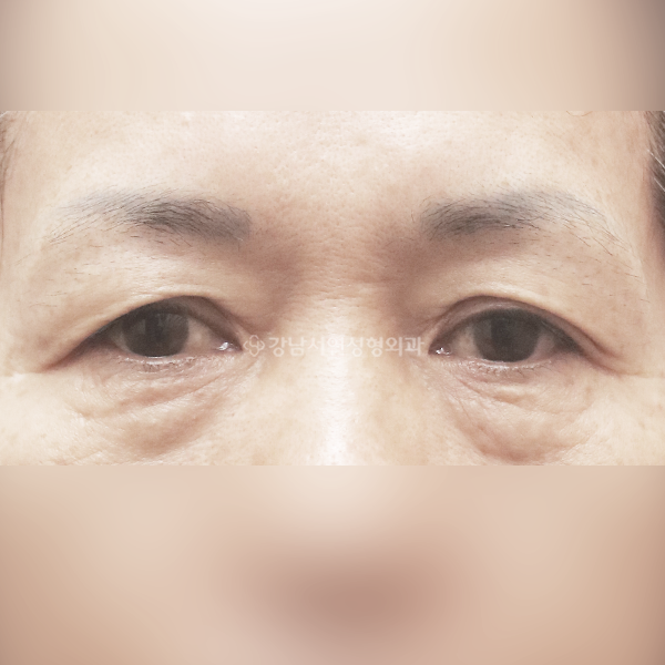 상안검+하안검 BEFORE