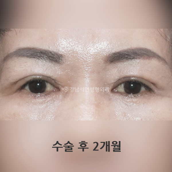 상안검+하안검 AFTER